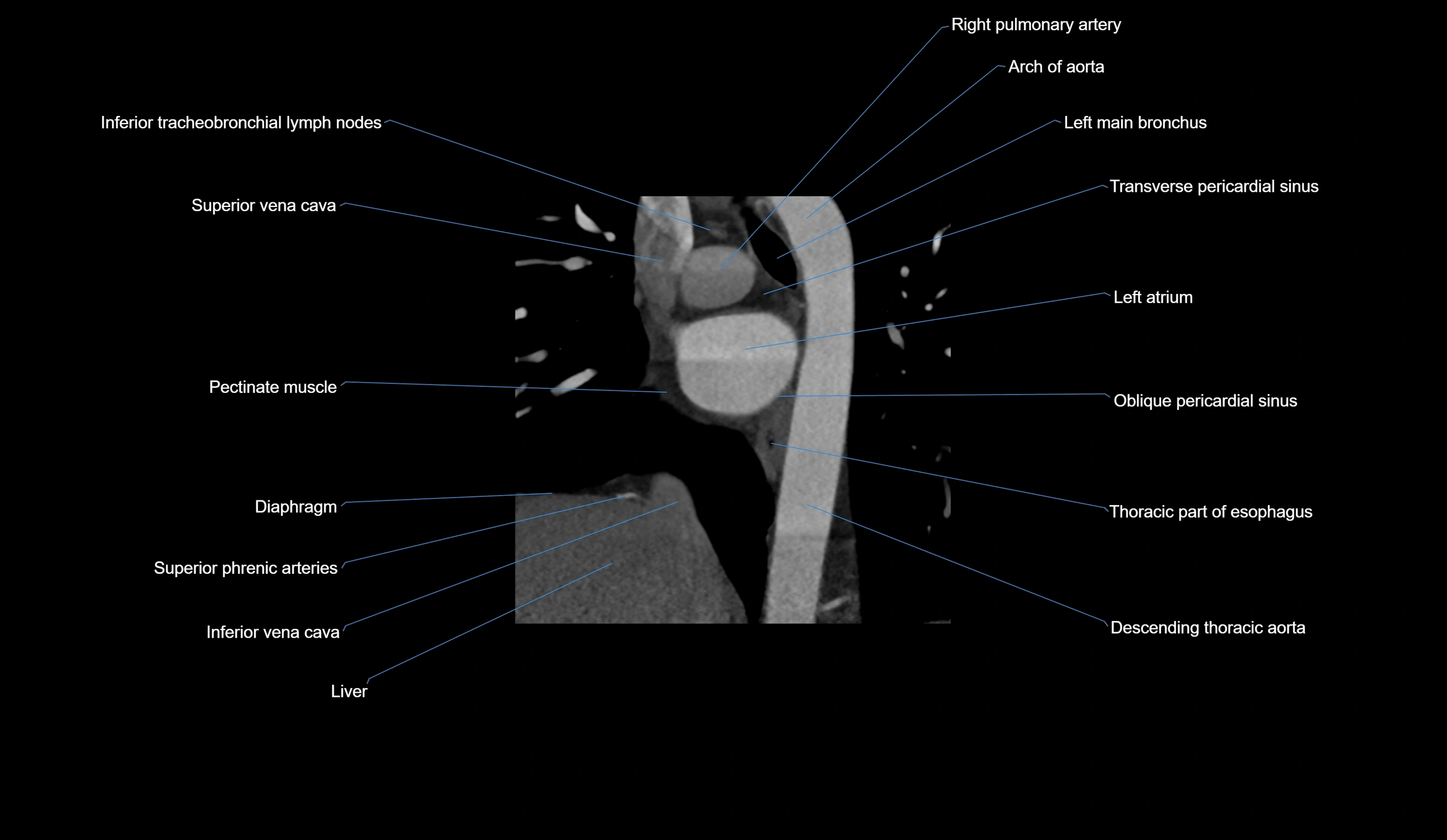 CT heart (coronary angiogram) short axis view  cross sectional anatomy labelled radiology image-00009.webp